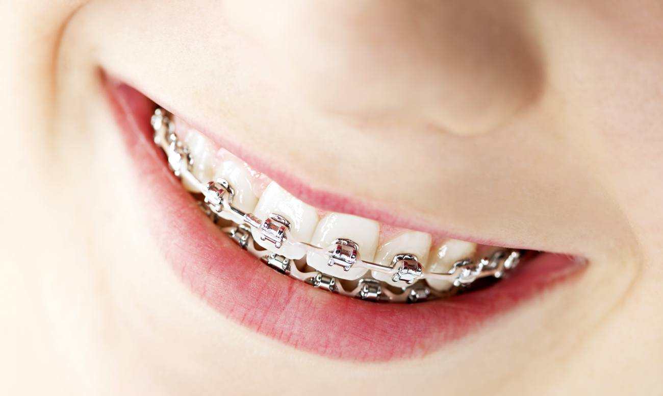 Скобы для зубов металлические